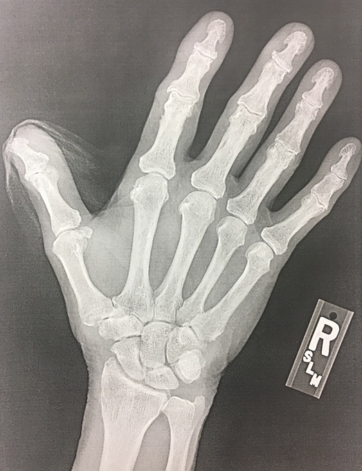 X-ray of Bill's hand, minus the nail portion of the thumb